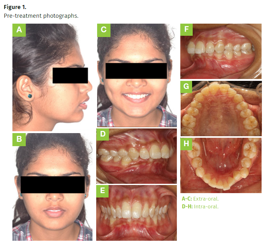 Incisor relation was Class II 