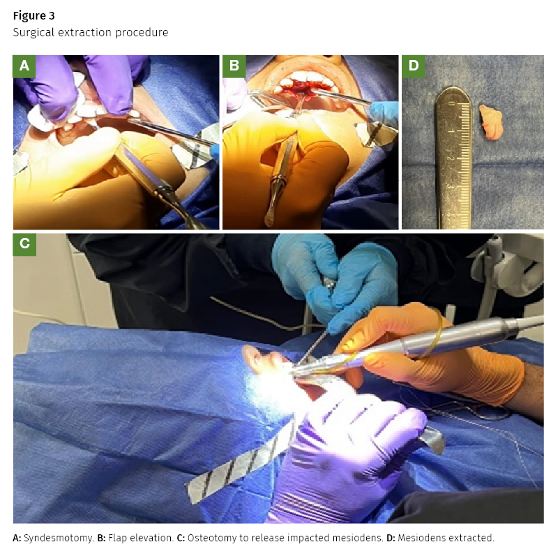supernumerary tooth