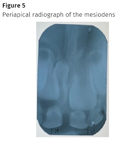 fused tooth 