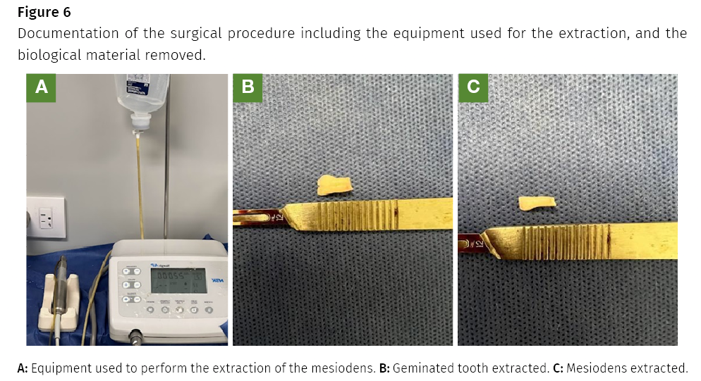 supernumerary tooth