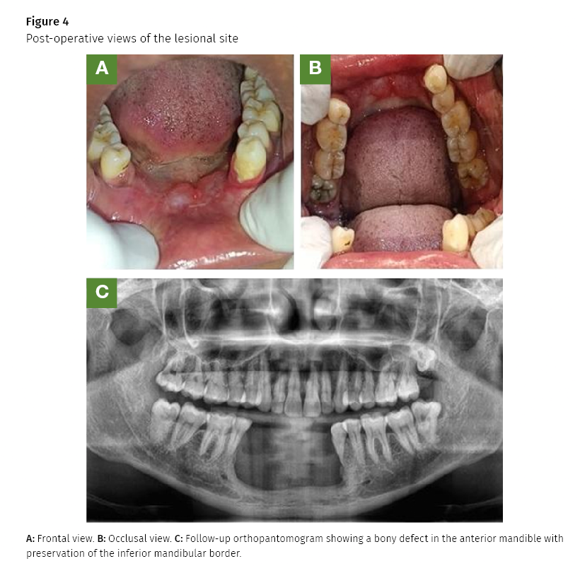 supernumerary tooth